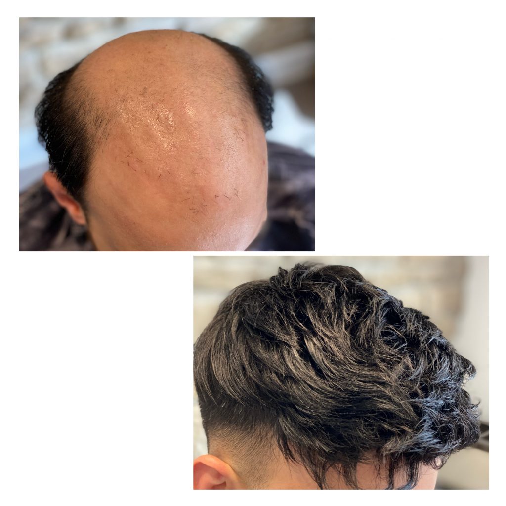 Complément capillaire homme (avant / après) - Hair Tendance